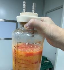 南平水动力吸脂手术要做多久？